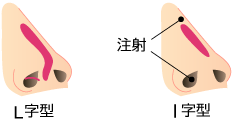 局所麻酔で鼻の付け根（鼻根部）と、右の鼻の中の2ヵ所に麻酔注射をします。