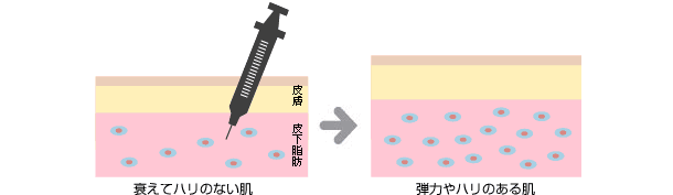 血小板から放出された成長細胞が老化した顔の皮膚細胞を再生し、新生血管を作りコラーゲン機能を活発にしてヒアルロン酸を作り出し、肌全体の若返りを図っていきます。