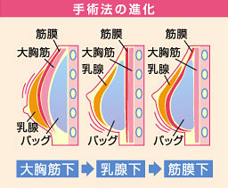 手術法の進化