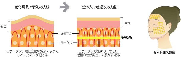 直径0.1mmの金の糸を真皮層に入れることにより、免疫細胞が活性化し、ターンオーバー（新陳代謝）のリズムを取り戻します。