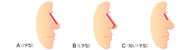 本人の希望に合わせてデザインされたシリコンプロテーゼを、鼻筋に通すように挿入します。