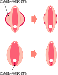 小陰唇を小さく、膣縮小