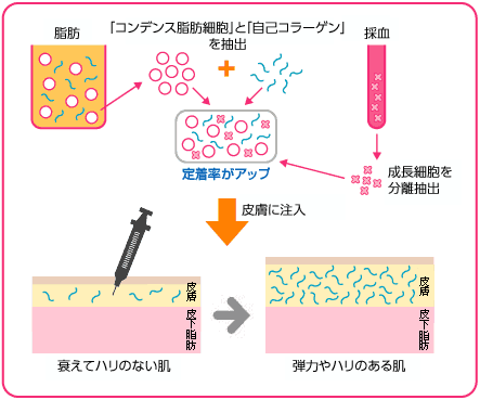 ヘソの中に3～4mmの小さな穴を開け、ヘソの周りのお腹の脂肪を少量（20～30cc）、脂肪吸引で吸い出します。吸引したキレイな脂肪からコンデンス脂肪細胞と自己コラーゲンを遠心分離器で抽出します。自分の血液をさらに20ccほど採血し、そこから血小板や線維芽細胞などの成長因子を抽出して、自己コラーゲンとコンデンス脂肪細胞に混ぜます。